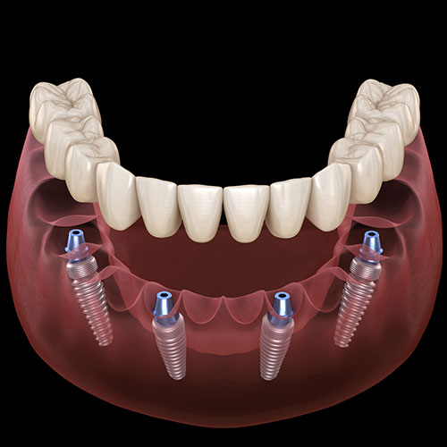 dentures